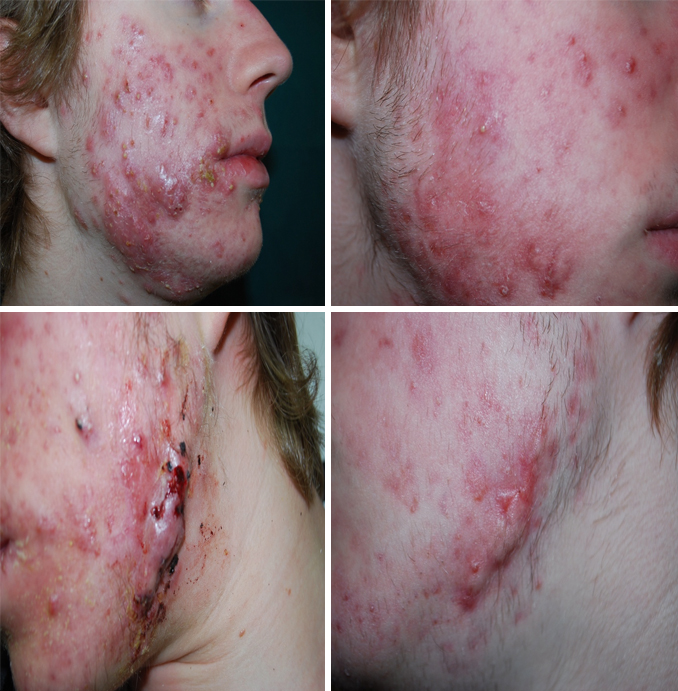 Francesco Bruno - Acne Severa Nodulo Cistica