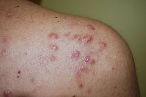 Acne cheloidea