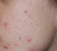 Acne comedonica