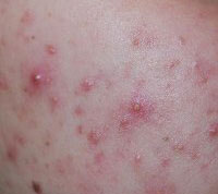 Acne Inversa