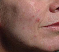 Acne Tardiva