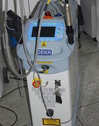 neodimio-yag laser
