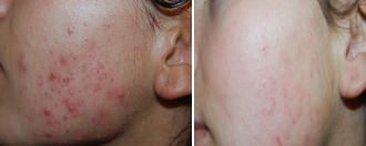 Acne papulo-pustolosa