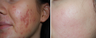 Acne nodulo-cistica