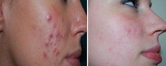Acne nodulo-cistica