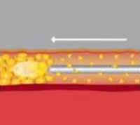 Acne comedonica