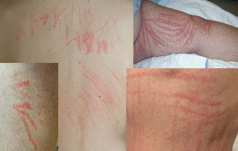 Dermatite flagellata da sushi o sashimi Dermatite flagellata da sushi o sashimi